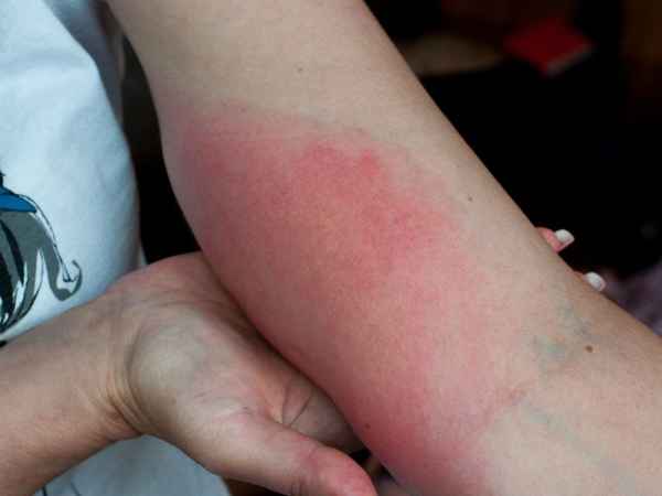 Bị ong đốt hên hay xui